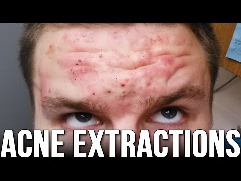 Acne Extractions Retin-A & Accutane (Week 67)