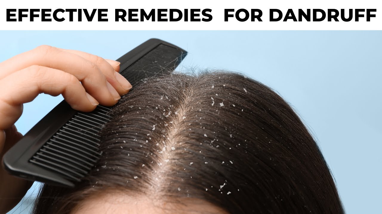 5 Natural Remedies to Cure Dandruff￼