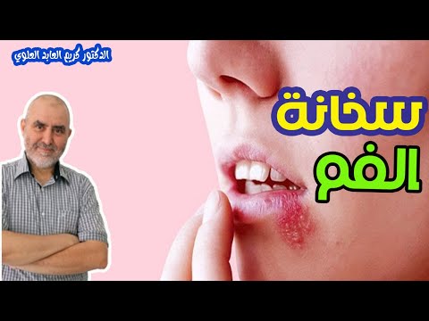 طرق طبيعية للتخلص من سخانة الفم أو ليزافت   -  الدكتور كريم العابد العلوي  -