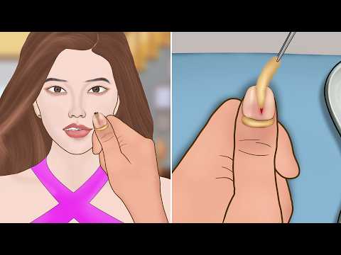 ASMR Remove Huge Splinter From thumb finger | Severely injured animation