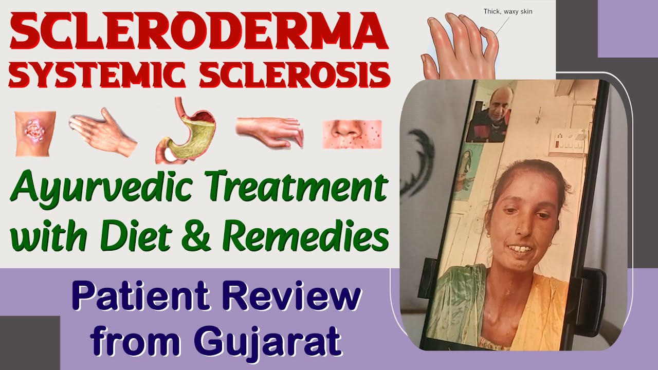 Watch Video Scleroderma/Systemic Sclerosis Treatment - Ayurvedic Diet & Remedies | Patient Review from Gujarat