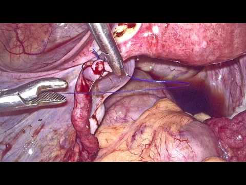 tubal laparoscopic bilateral recanalization cpt ligation
