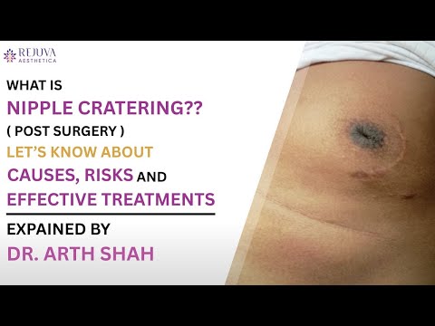 What is nipple cratering? Understand its causes, risks, and best treatments in this quick guide!