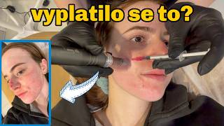 VYZKOUŠELA JSEM MIKROJEHLIČKOVÁNÍ ABYCH SE ZBAVILA JIZEV PO AKNÉ // VLOG 3 DNY