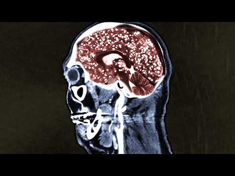 A Man Ate Pork Tacos From An Illegal Food Truck. This Is What Happened To His Brain.