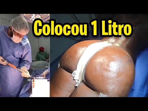 FEZ ENXERTO BUMBUM E COLOCOU 1 LITRO GORDURA DA LIPO!! Dr Valter Hugo