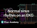 EKG Interpretation and Analysis