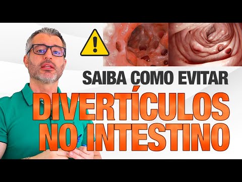 O que você precisa saber para não ter uma DIVERTICULITE