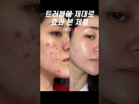 트러블에 제대로 효과 본 제품(광고❌)