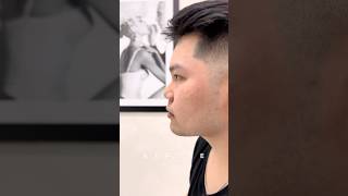 Male Asian Rhinoplasty Before and After #nosejob #rhinoplasty