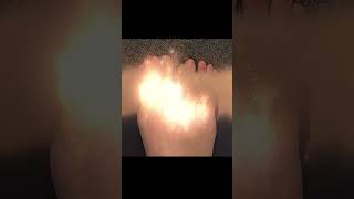 ULTRA TOE SHORTENING SURGERY🤩#shorts #toeshorteningsurgery #toeshortening