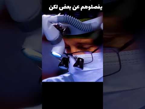 بتجري الأطباء جراحه لفصل التؤام عن بعض
