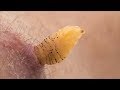 Understanding Botfly Larvae and Their Effects