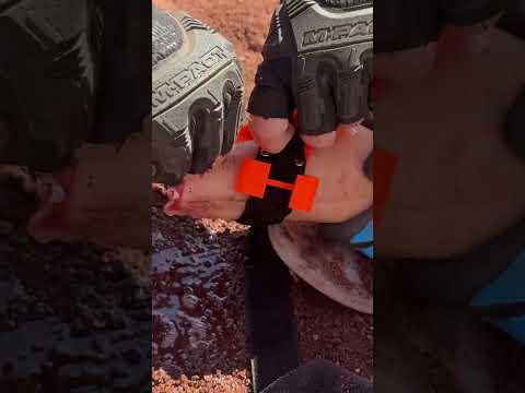 How to apply a Gaza (or CAT) style tourniquet - Glia.org