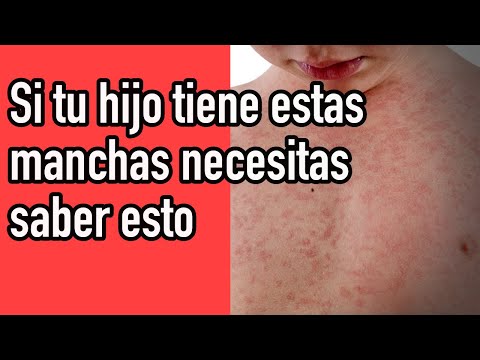 ¡Alerta para padres! Puntos rojos en la piel de tu hijo: ¿Qué debes saber?