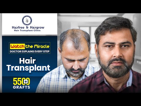 Dr. Kiran Chotaliya Presents: Full Hair Restoration Case Study | Grade 5-6 Baldness Treated with FUE