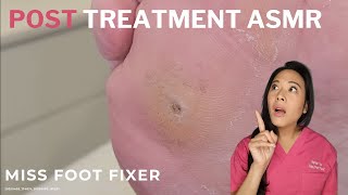 Post-Op Verruca Treatment by MissFootFixer