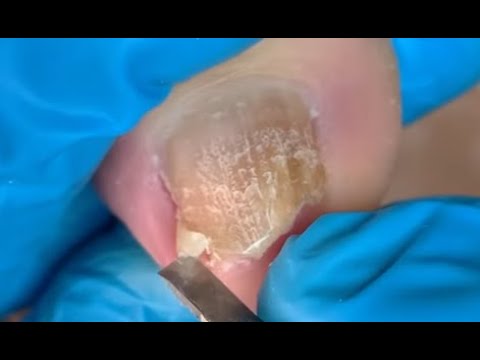 How to repair nails