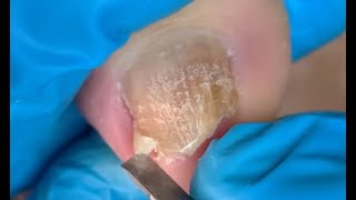 How to repair nails