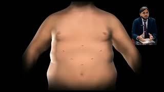 Obesity treatment/Surgery for Obesity, Sugar and Blood pressure..