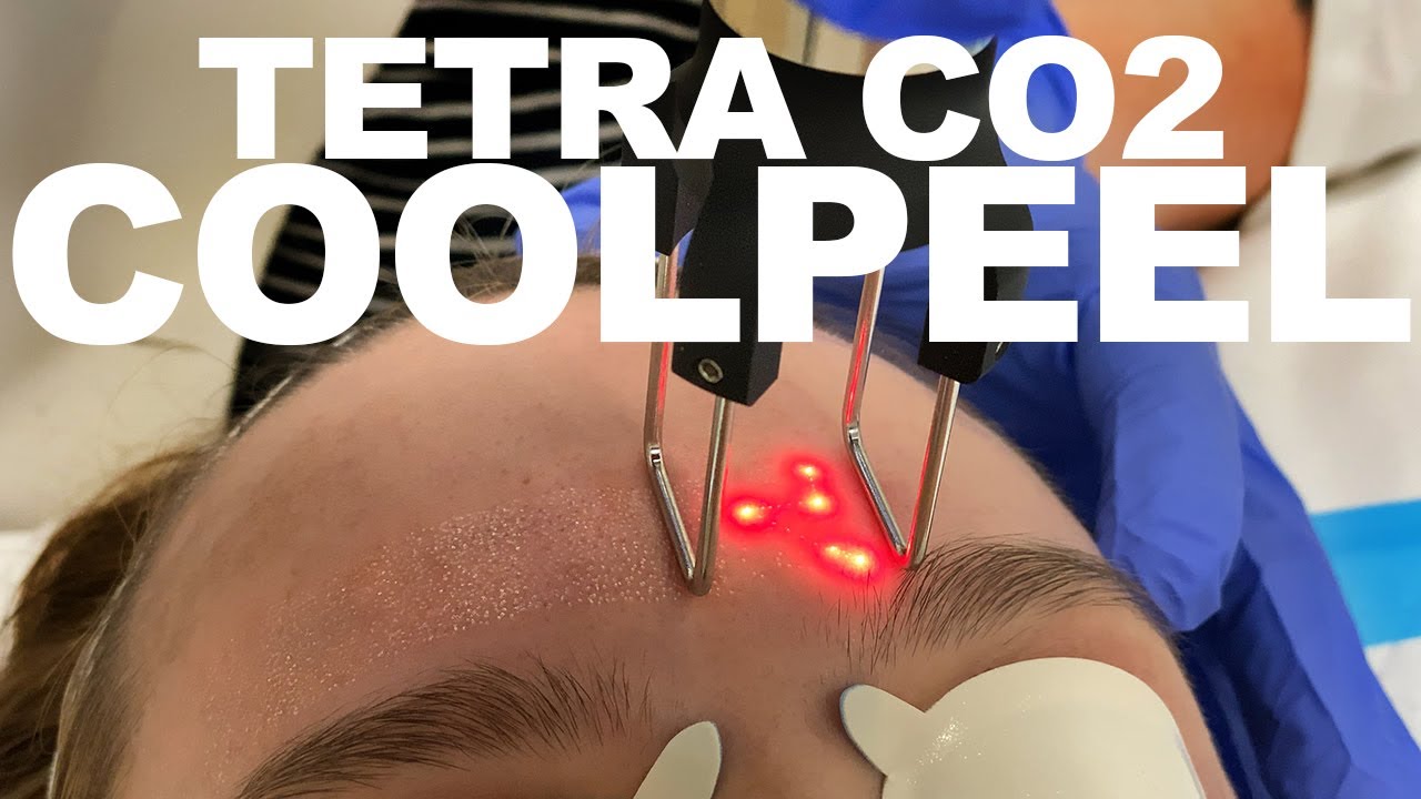 CO2 laser treatment on a patient's forehead.