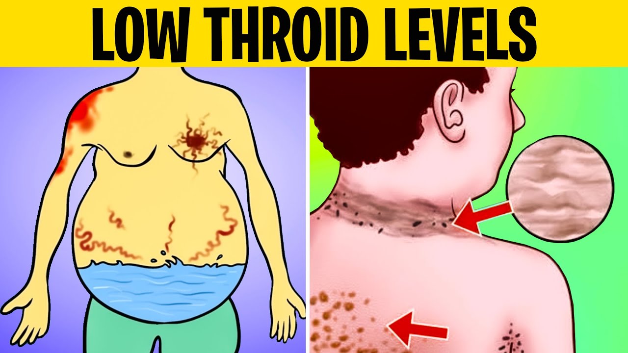 12 Signs That You Have a LOW THYROID LEVEL
