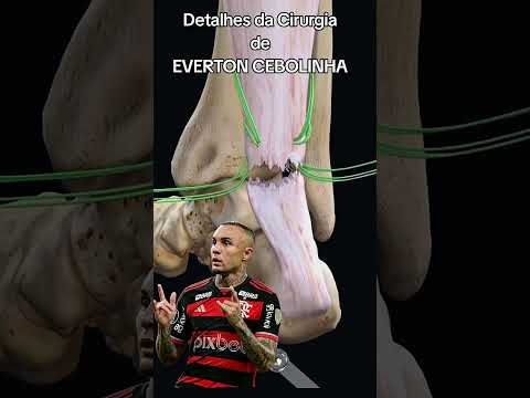 detalhe cirugia everton cebolinha !