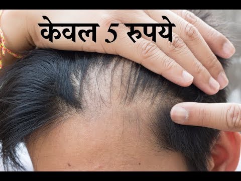 केवल 5 रुपये में गंजे सिर पर बाल उगाने का सबसे कामयाब घरेलू नुस्खा!