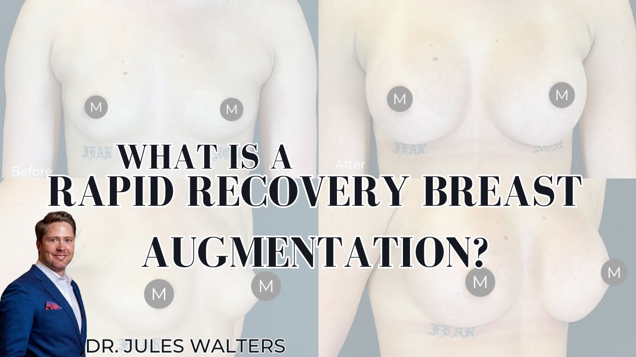 Before and after breast augmentation comparison image.