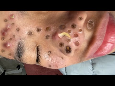 Blackhead Removal With Sac Dep Spa @100074045