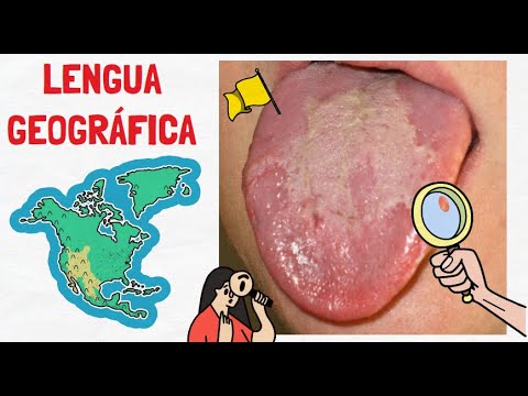 LENGUA GEOGRÁFICA | QUÉ ES Y CÓMO SE CURA?