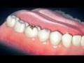 Dental Crowns: Care and Considerations