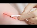 Understanding Wounds