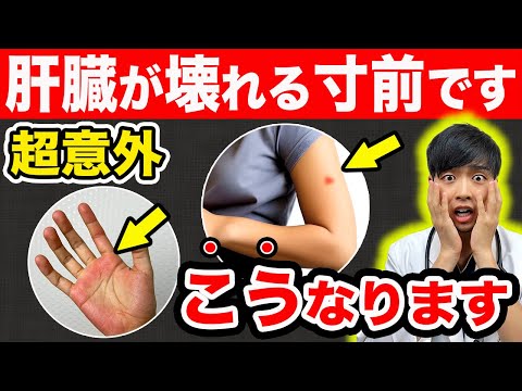 【放置危険】肝臓が壊れる寸前のサイン、こうなります。【テレビじゃ言えない】現役医師解説