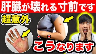 【放置危険】肝臓が壊れる寸前のサイン、こうなります。【テレビじゃ言えない】現役医師解説