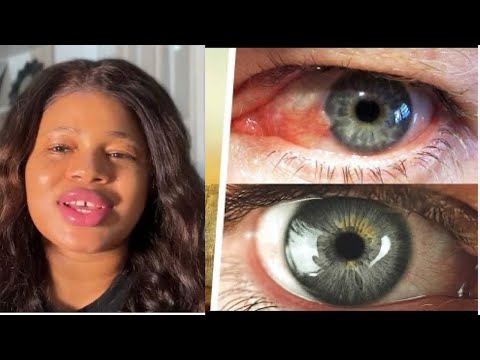 YOU NEED THESE FOODS FOR YOUR EYES HEALTH