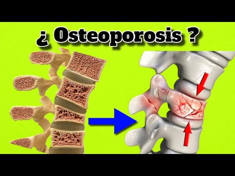 Remedios Caseros para la Osteoporosis Curar y Quitar Dolor de Huesos Tratamientos Naturales 2025