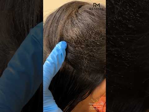 ഞെട്ടരുത് ? #myna #mynawings #beautyandfashion #liceremove #lice #lice