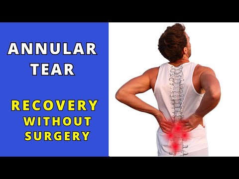 Annular Tear Recovery without surgery