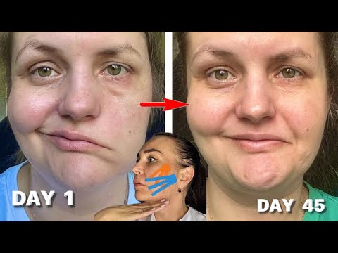 IMPORTANT exercises for Bell’s Palsy ( FACIAL PARALYSIS )