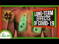 Understanding Long-term Effects of COVID-19