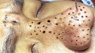 Blackhead Removal With Sac Dep Spa @100074684