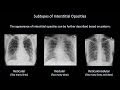 Radiology: Lung Patterns and Conditions