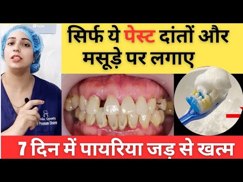 Pyorrhea Treatment At Home | पायरिया का घरेलु इलाज | Home Remedies For Periodontitis