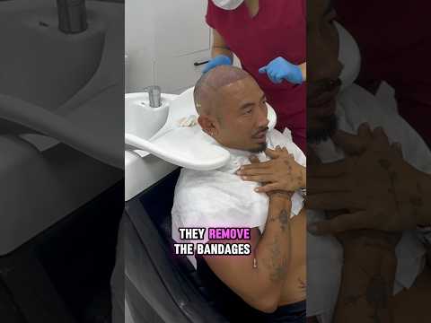 Hair transplant update . 5 weeks post op. 4500 grafts. #hairtransplant #hairsurgeon #hairclinic