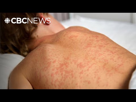 YouTube video thumbnail: Alberta Measles Outbreak 'an Appalling Situation,' Says Infectious Diseases Specialist