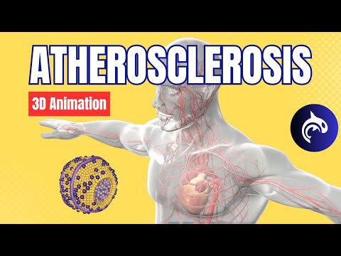 Learn about Atherosclerosis - 3D Animation