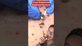 Truly Shocking BLACKHEAD REMOVAL #shorts