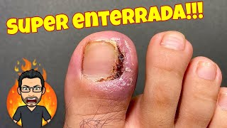 EXTRACCION DE UÑA ENCARNADA DOLOROSA