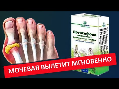 Оказывается подагра боится обычной ... Как избавиться от приступов подагры ?